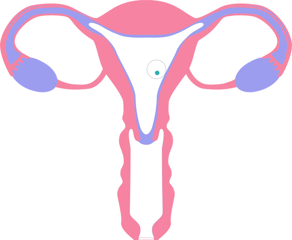Eine schematische, farbige Illustration der weiblichen Fortpflanzungsorgane (Uterus, Eileiter und Eierstöcke) in Pink und Lila. In der Gebärmutterhöhle ist eine kleine, grün markierte Eizelle zu sehen, die den Vorgang der Einnistung in die Gebärmutterschleimhaut darstellt. Die Grafik verdeutlicht den biologischen Erfolg einer geplanten Schwangerschaft.