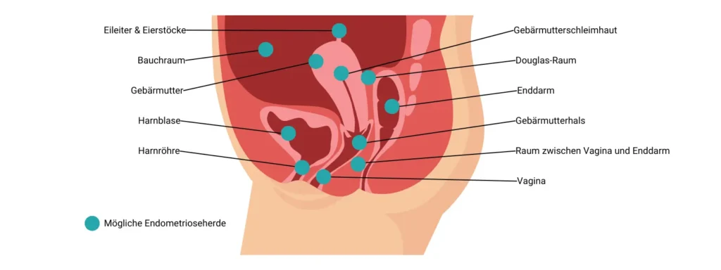 trackle und Endometriose